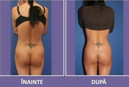 Pippa mania loveste si Romania! Medicii esteticieni pot sa iti faca un fund ca al ei! Vezi cat costa!