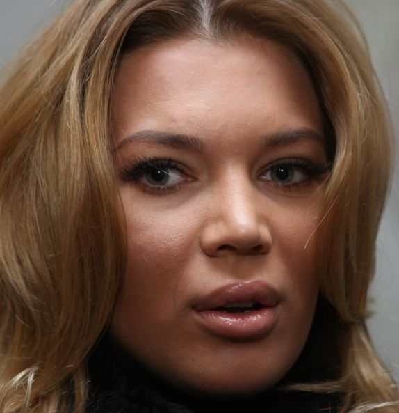 Adevaruri socante despre Botox si acid hialuronic: creeaza dependenta, iti pot paraliza fata si iti distrug buzele&nbsp;pe viata&nbsp;