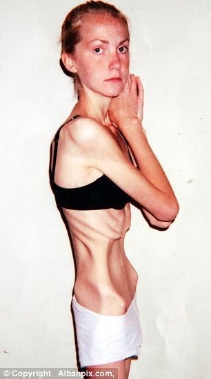 A ajuns la 31 de kilograme si a fost la un pas de moarte: o hraneau printr-un tub. Vezi cum a invins anorexia