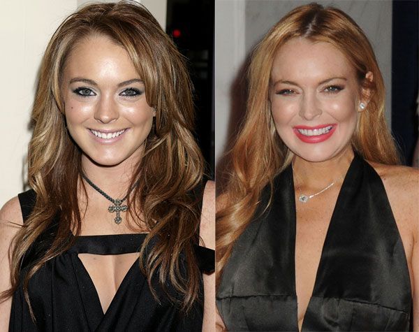 Zambet deformat de acid hialuronic. Vezi cum au ajuns sa arate buzele lui Lindsay Lohan