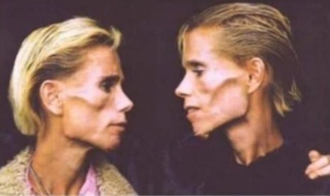 Gemenele anorexice care cantareau 25 de kilograme la 42 de ani. Vezi ce sfarsit tragic au avut