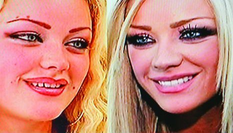Bianca Dragusanu a cheltuit o suma fabuloasa pentru o dantura perfecta. Cum avea vedeta dintii inainte de interventie