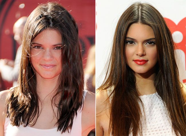 Un chirurg plastic sustine ca Kris Jenner i-a facut o rinoplastie fiicei sale minore, Kendall. Imaginile care demonstreaza spusele lui
