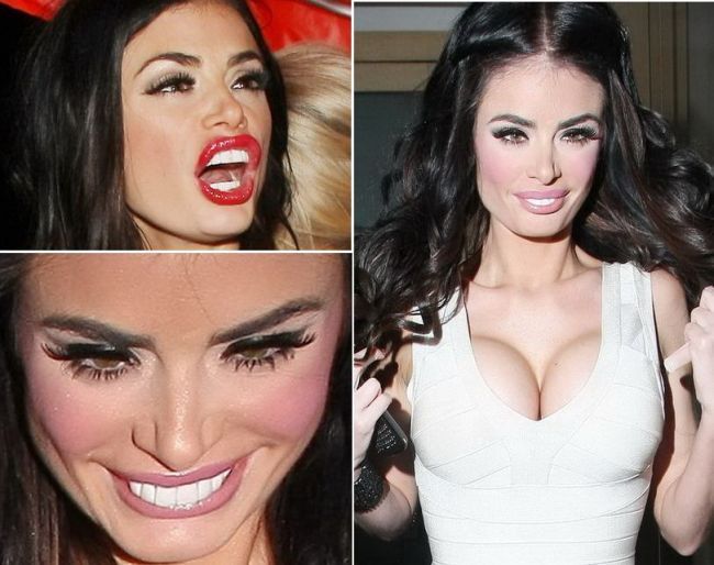 Mi-au zis ca am dinti de cal . Cum arata Chloe Sims dupa ce a platit peste 38.000 de lire pentru a-si reface dantura