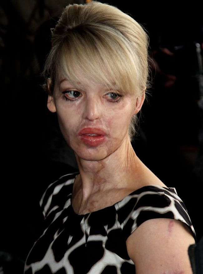 Aparitie impecabila a femeii pe care iubitul a desfigurat-o cu acid. Cum arata acum Katie Piper