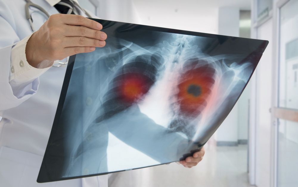 Simptomele cancerului pulmonar, boala care a răpus-o pe actrița Florina Cercel, dar și pe primul ei soț