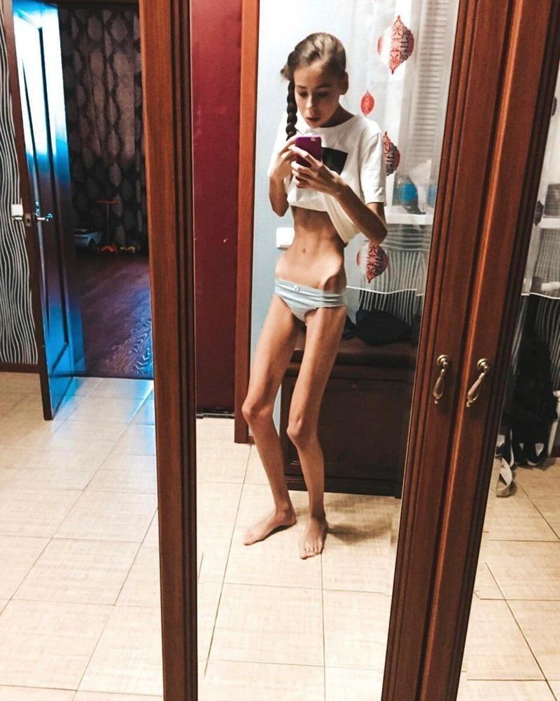 Povestea gemenelor care s-au luptat cu anorexia la 14 ani. Cum arată &icirc;n prezent